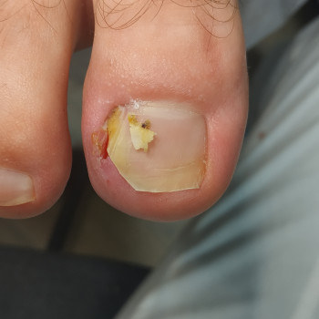 Удаление осколка