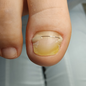 Восстановление ногтей с онихолизом