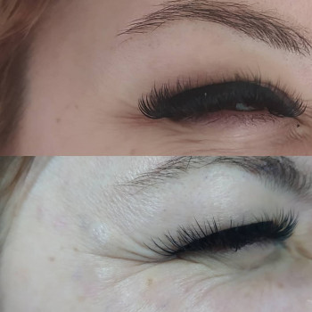 Ботулінотерапія
                    Дерматолог косметолог Юлия Біла Церква