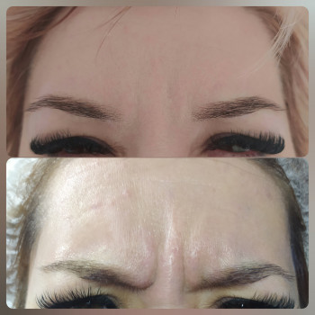 Ботулінотерапія
                    Дерматолог косметолог Юлия Біла Церква