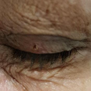 Удаление папиллом
                    Косметолог Мария Київ