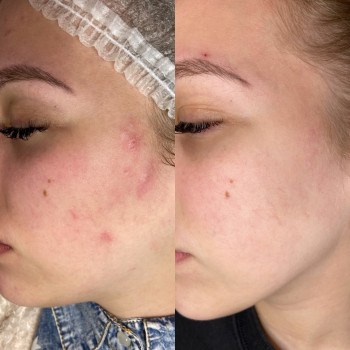 Чистка обличчя
                    Салон краси Sweet Skin Київ