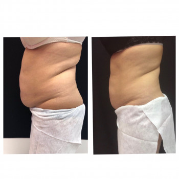 Криолиполиз
                    Медицинский центр Aesthetics Hall Clinic Днепр