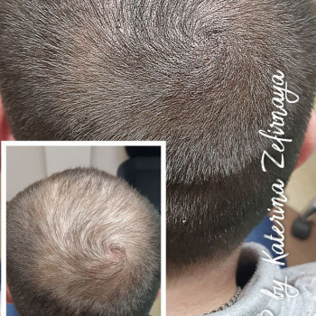 Трихопигментация алопеции