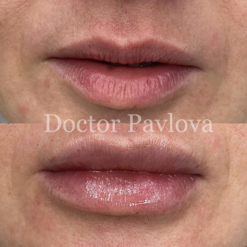 Увеличение губ