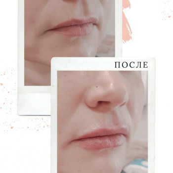 Увеличение губ