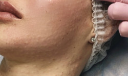 Биоревитализация Медицинский центр Aesthetics Hall Clinic Днепр