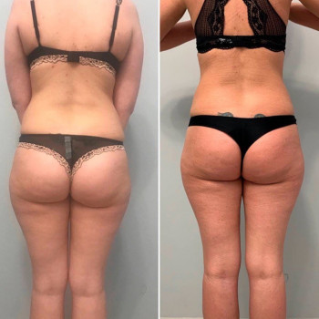 LPG- массаж
                    СПА-салон Beauty room Харьков