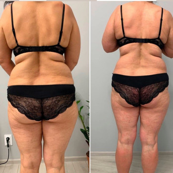 LPG- массаж
                    СПА-салон Beauty room Харьков