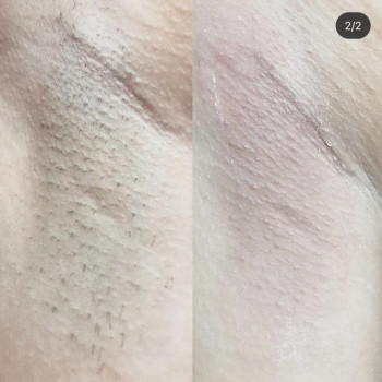 Больше не нужно отращивать. Депиляция от недели после послед