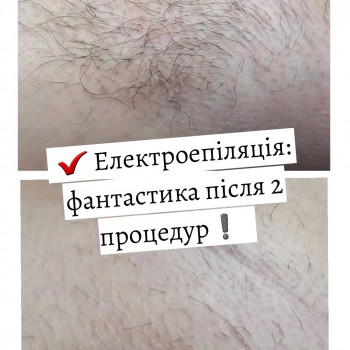 Электроэпиляция
                    Электролог Надежда Киев