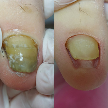 Робота з грибковим нігтем
                    Подолог Татьяна Викторовна Запорожье