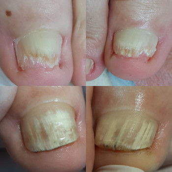 Робота з грибковим нігтем
                    Подолог Татьяна Викторовна Запорожье