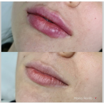Аугментация губ 
Объем:1ml
Препарат: Juvederm ultra 3