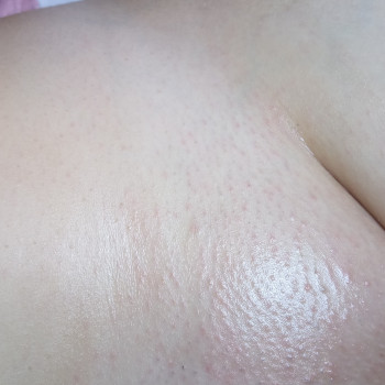 Глубокое бикини
Сразу после
Покраснение сойдёт в течении пар