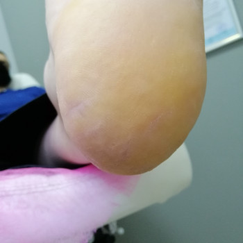 Після процедури - ліва нога.