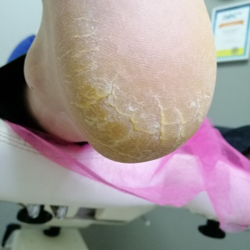 До процедуры-права нога.