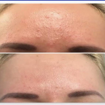 Чистки лица