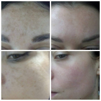 Терапия гиперпигментаций