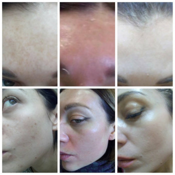 терапия гиперпигментаций