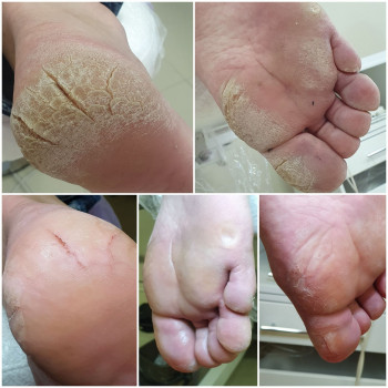 Обробка тріщин та гіперкератозу!