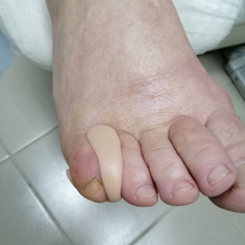 Виготовлення ортозів - індивідуальних засобів для розвантаже