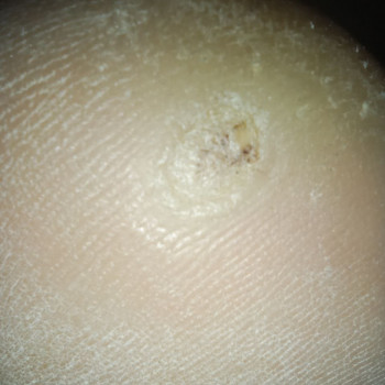 Виведення бородавок
                    Подолог Олена Львов