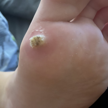 Виведення бородавок
                    Подолог Олена Львов