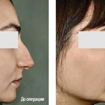 Ринопластика