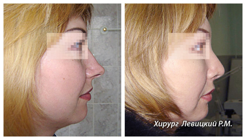 Ринопластика, фото - Медицинский центр Киевский областной центр пластической хирургии
