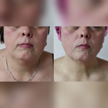 Rf лифтинг. Одна процедура. До и после