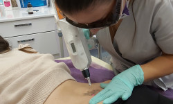 Удаление татуировок лазером Косметологический центр ASA LASER COSMETIC Киев