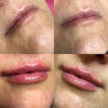 До та зразу після
0,5 мл препарату