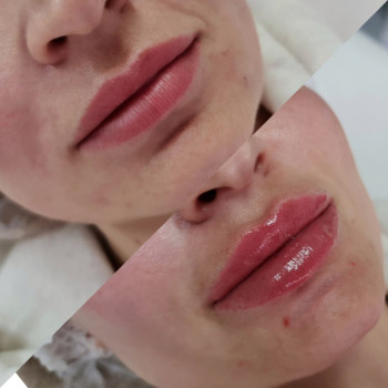 Увеличение губ