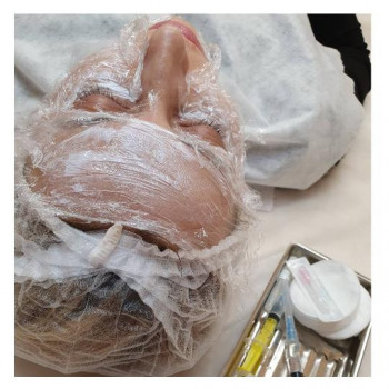 Биоревитализация