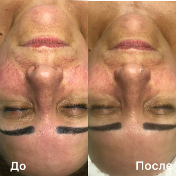 Микротоковая терапия