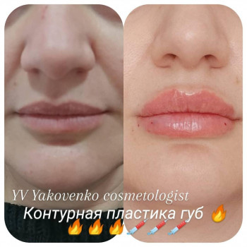 Контурная пластика губ