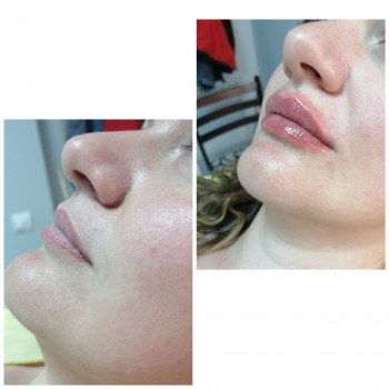 Моя работа Контурная пластика губ