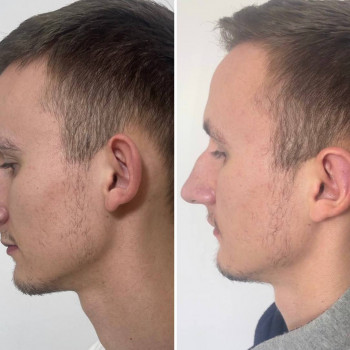 Отопластика (пластика ушей)
                    Пластический хирург Абдель Харьков