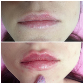 Збільшення губ