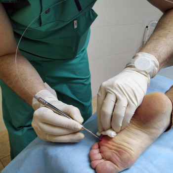 Удаление бородавок