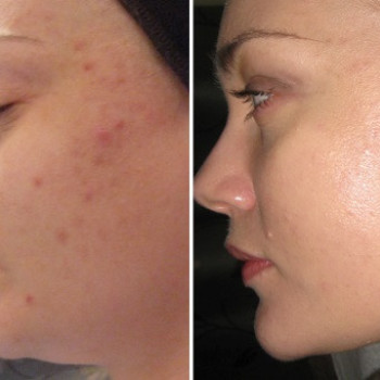 Уходовая программа "Комодекс" для жирной и проблемной кожи
                    Косметолог Инна Маріуполь