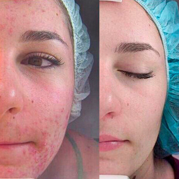 Уходовая программа "Комодекс" для жирной и проблемной кожи
                    Косметолог Инна Маріуполь