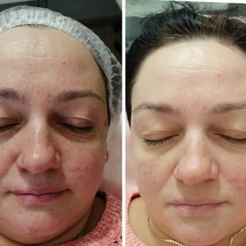 Уходовая программа "Комодекс" для жирной и проблемной кожи
                    Косметолог Инна Маріуполь