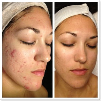 Уходовая программа "Комодекс" для жирной и проблемной кожи
                    Косметолог Инна Маріуполь