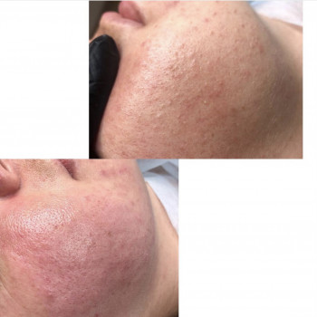 Процедура BioPhyto–линии для ухода за чувствительной, раздраженной кожей с признаками купероза
                    Косметолог Инна Мариуполь