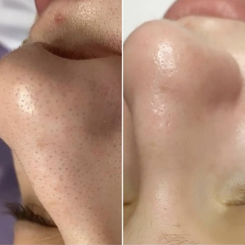 Процедура BioPhyto–линии для ухода за чувствительной, раздраженной кожей с признаками купероза
                    Косметолог Инна Мариуполь