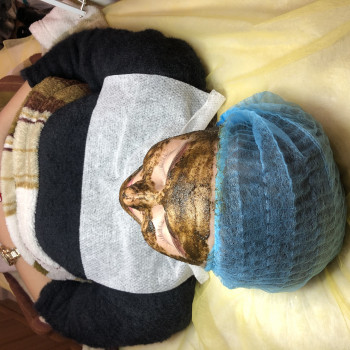 Процедура BioPhyto–линии для ухода за чувствительной, раздраженной кожей с признаками купероза
                    Косметолог Инна Мариуполь