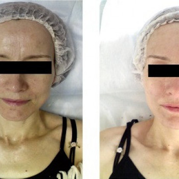 Программа Silk для моментального лифтинг эффекта
                    Косметолог Инна Мариуполь