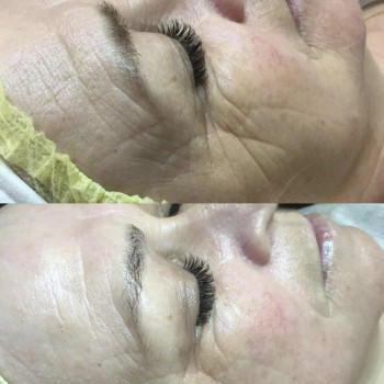 Программа Silk для моментального лифтинг эффекта
                    Косметолог Инна Мариуполь